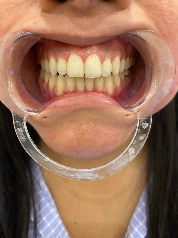 After Invisalign treatment