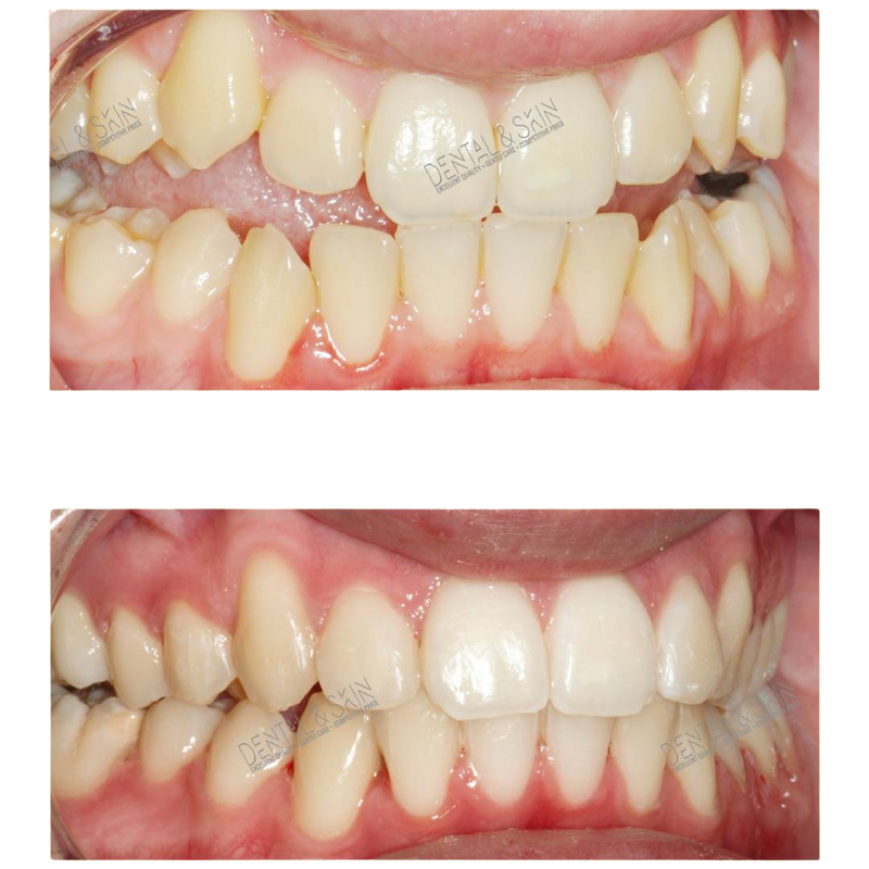 After Invisalign treatment