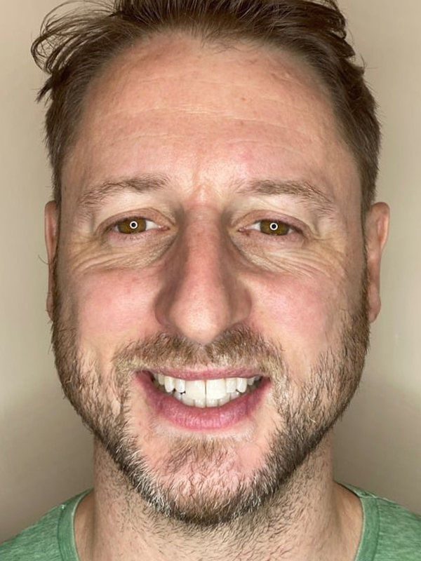 After Treatment