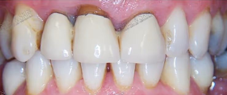 Before Treatment