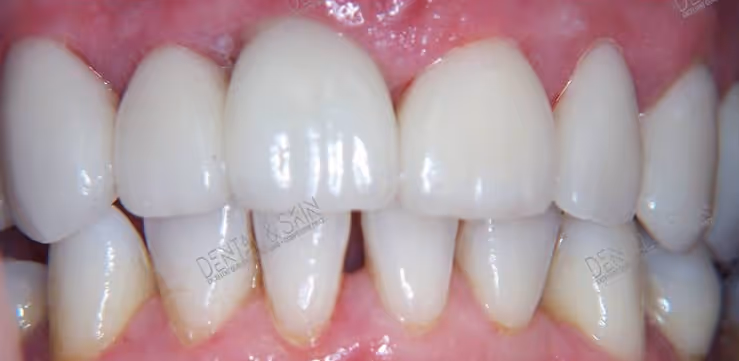 After Treatment