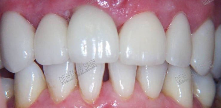 After Treatment