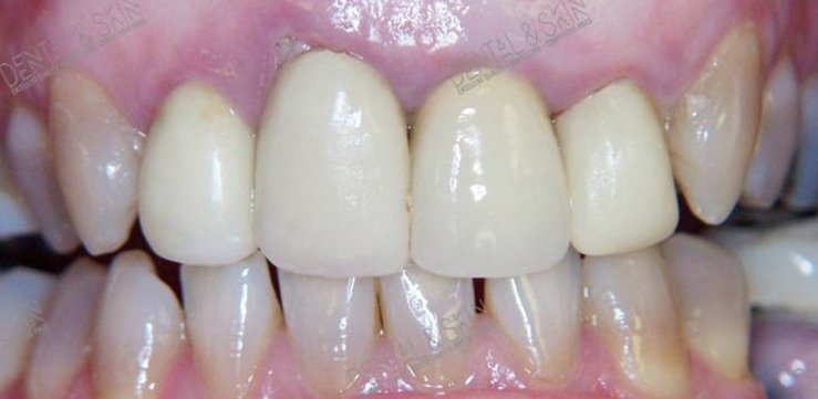 Before Treatment