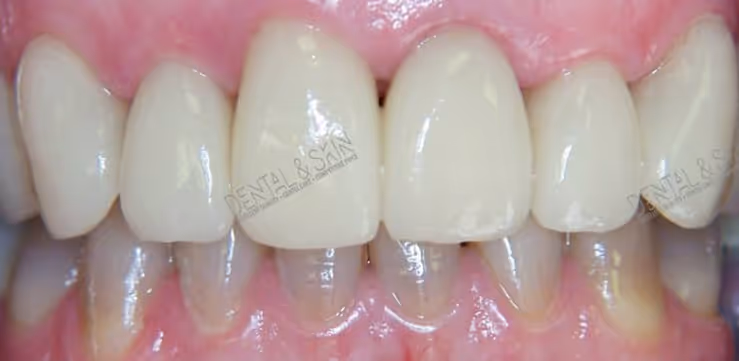 After Treatment