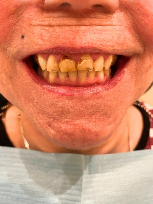 Before Treatment