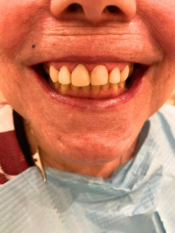 After Treatment