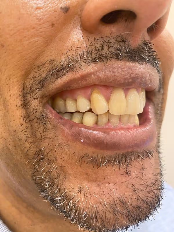 After Treatment