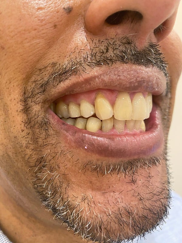 After Treatment