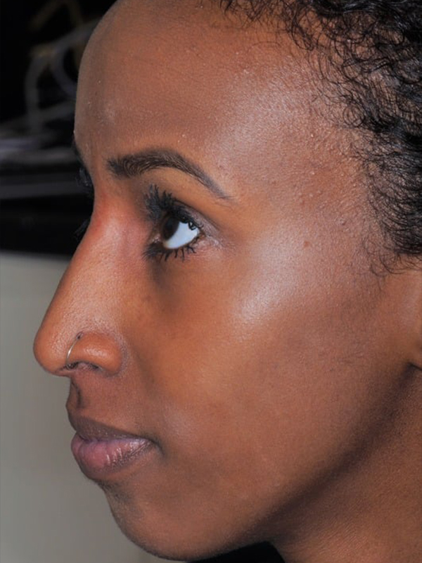 After Treatment