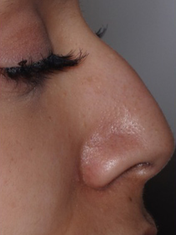 Before Treatment