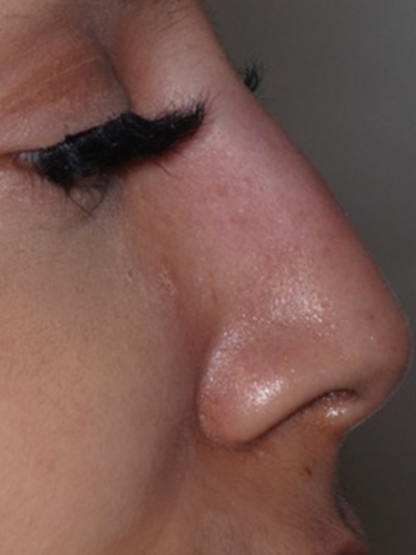 After Treatment