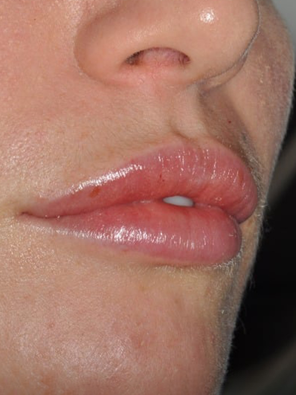 After Treatment