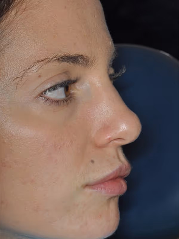 Before Treatment