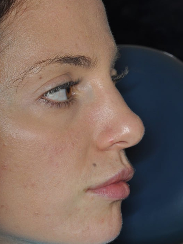 Before Treatment
