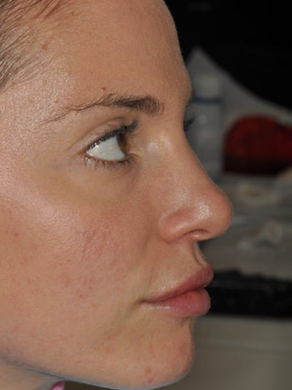 After Treatment