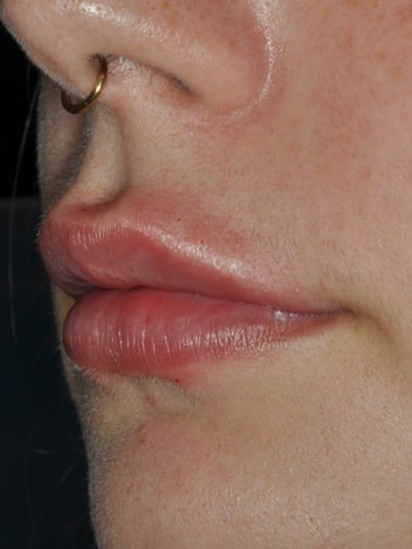 After Treatment