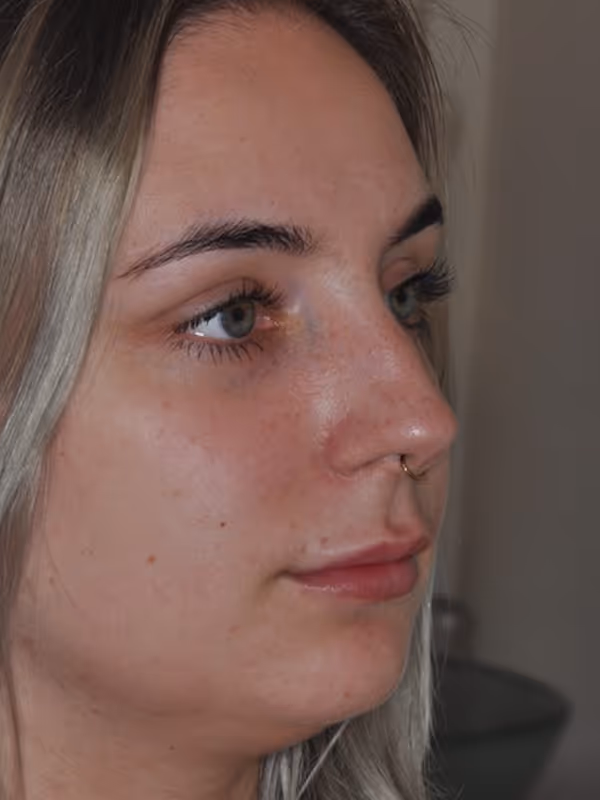 Before Treatment