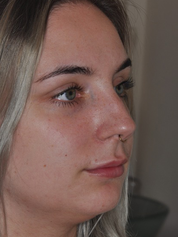 Before Treatment