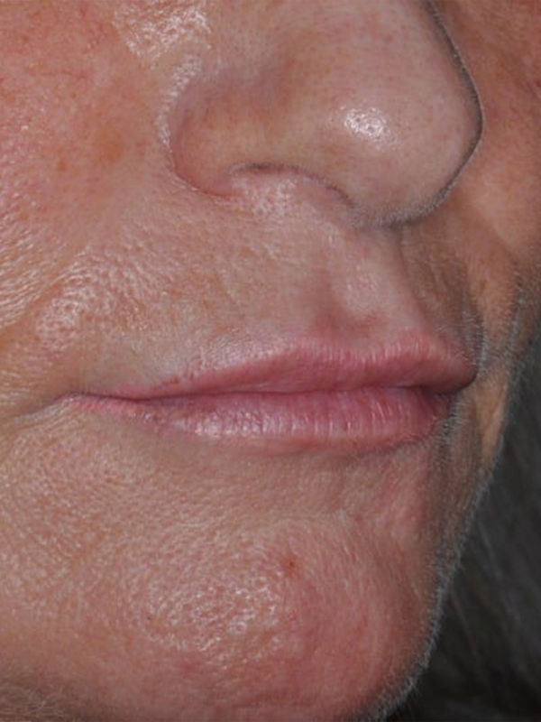 Before Treatment
