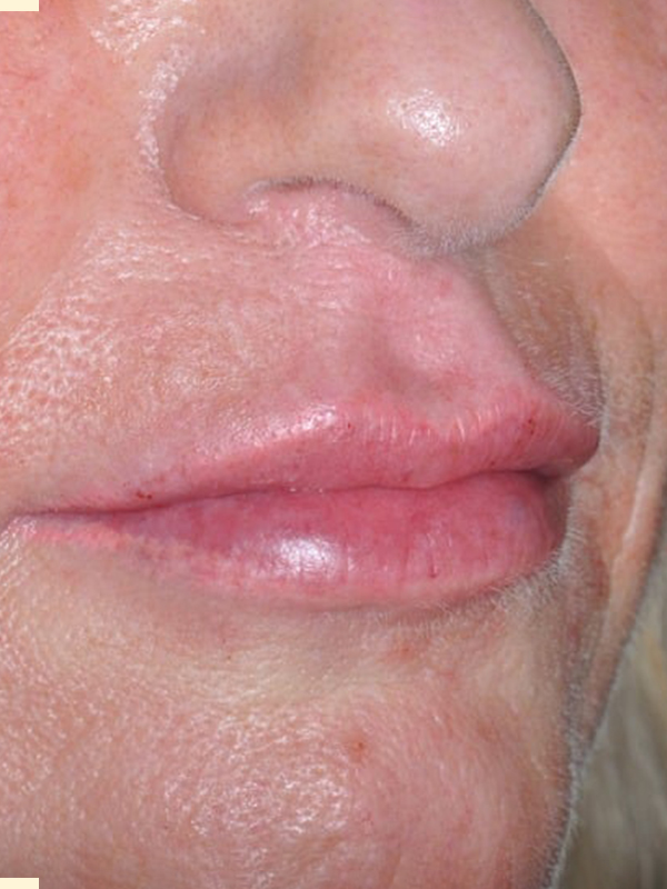 After Treatment