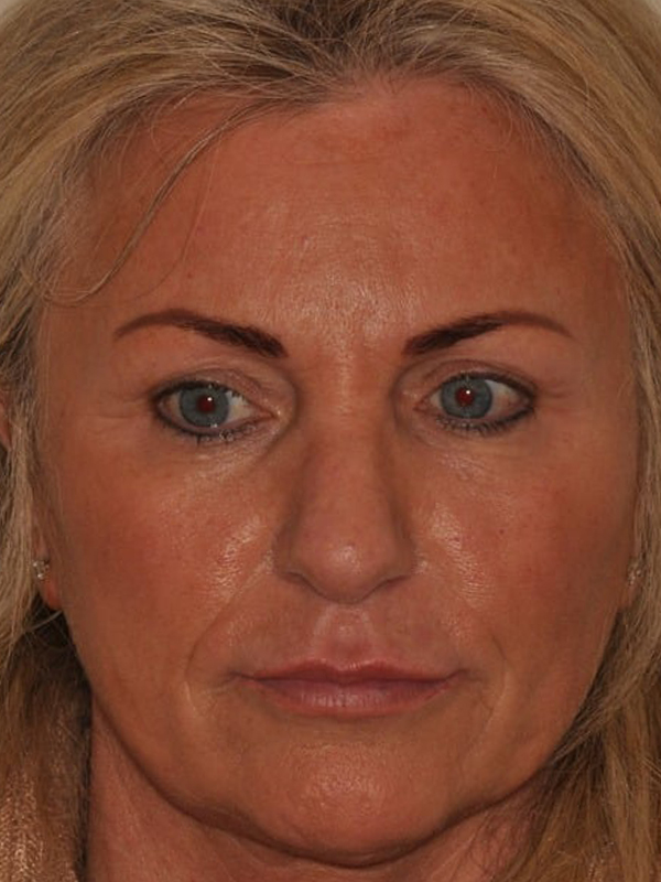 Before Treatment