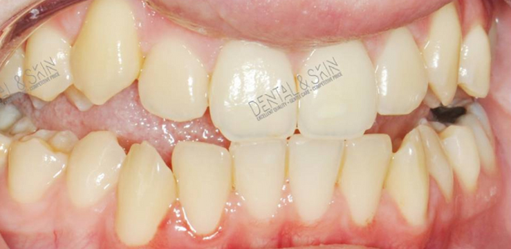 Before Treatment