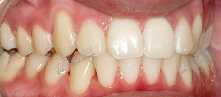 After Treatment