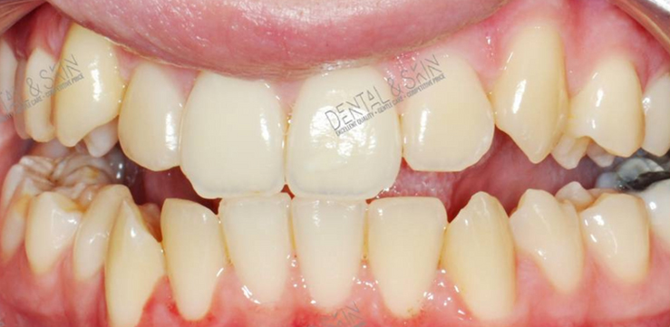 Before Treatment