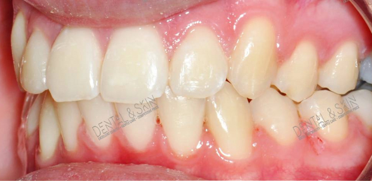 After Treatment