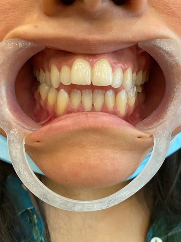 Before Treatment