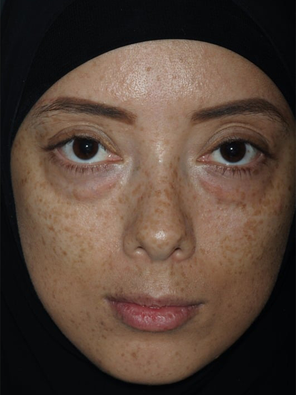 Before Treatment