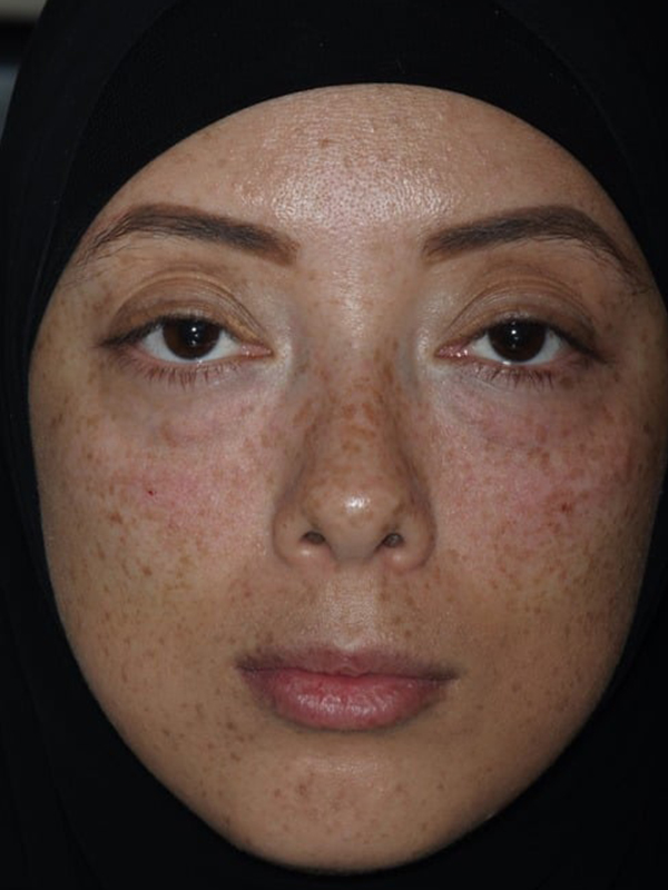 After Treatment