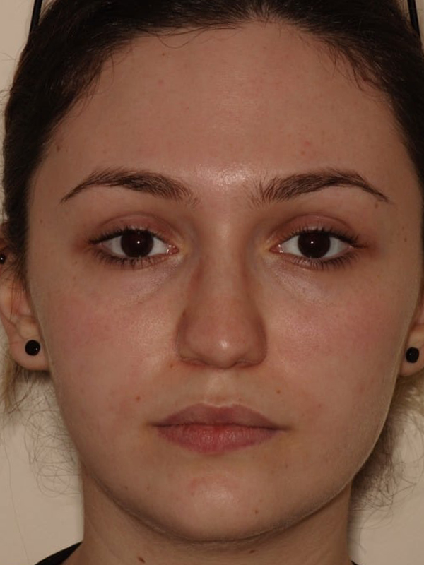 Before Treatment