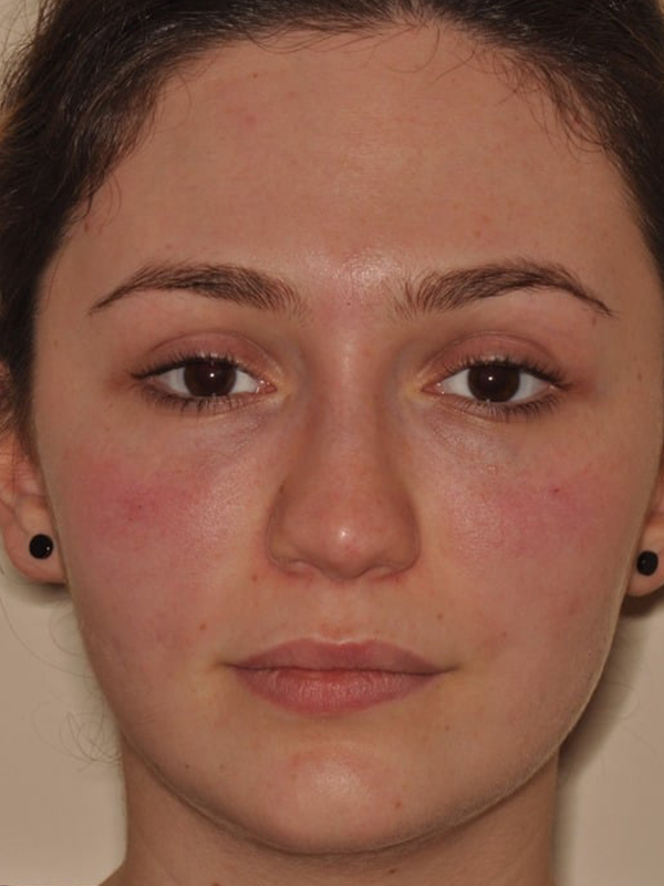 After Treatment