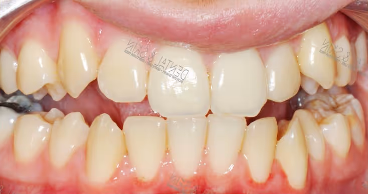 Before Treatment