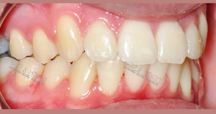 After Treatment