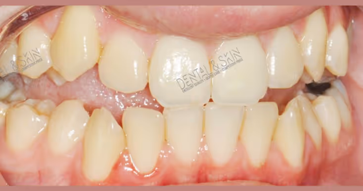 Before Treatment