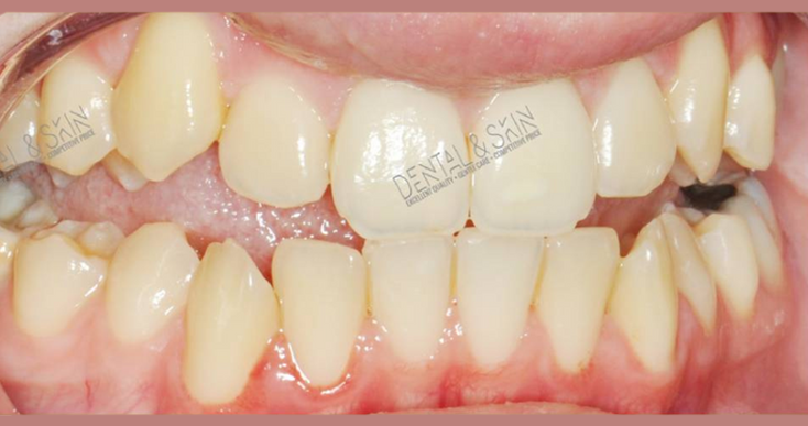 Before Treatment