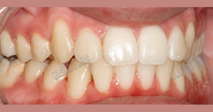 After Treatment