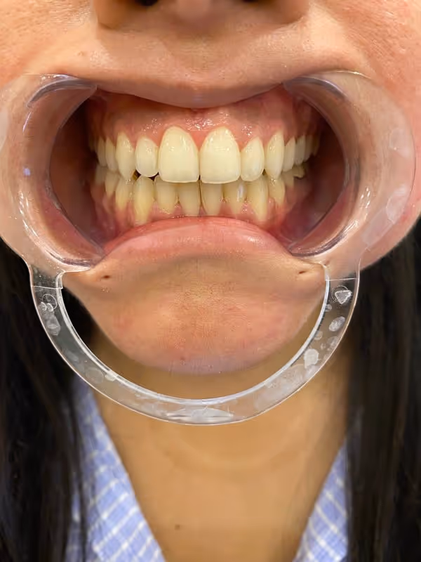 After Treatment