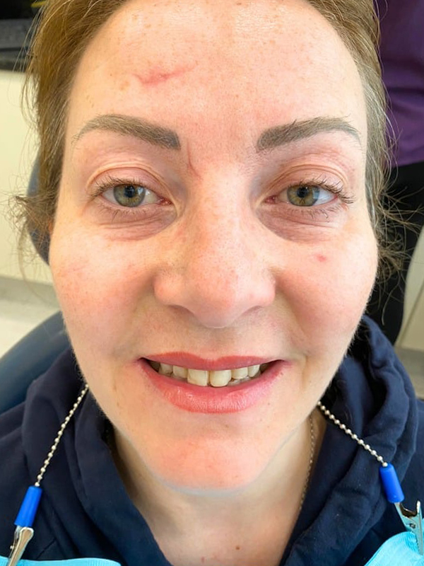 Before Treatment
