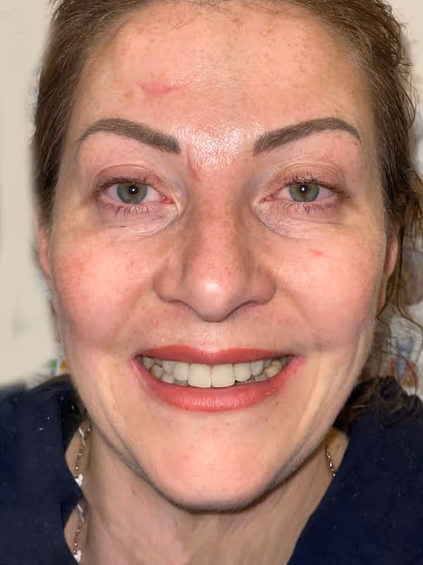 After Treatment