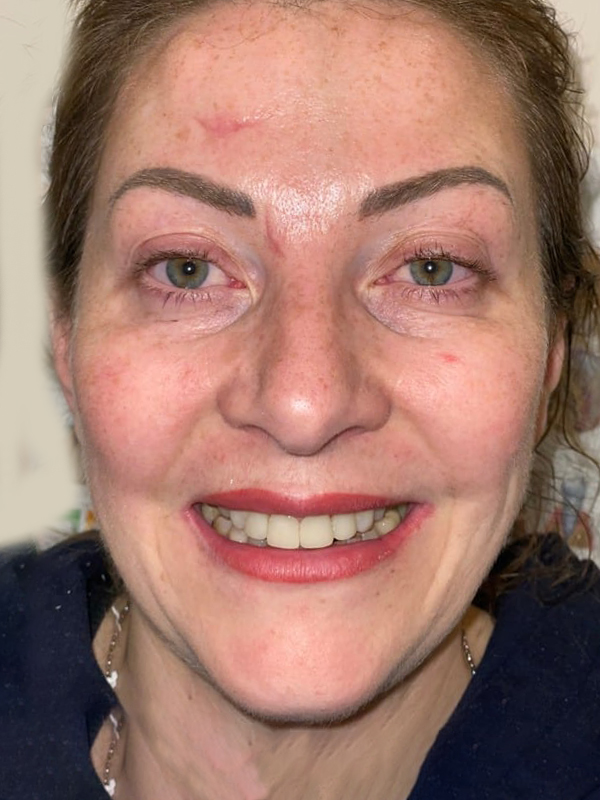 After Treatment