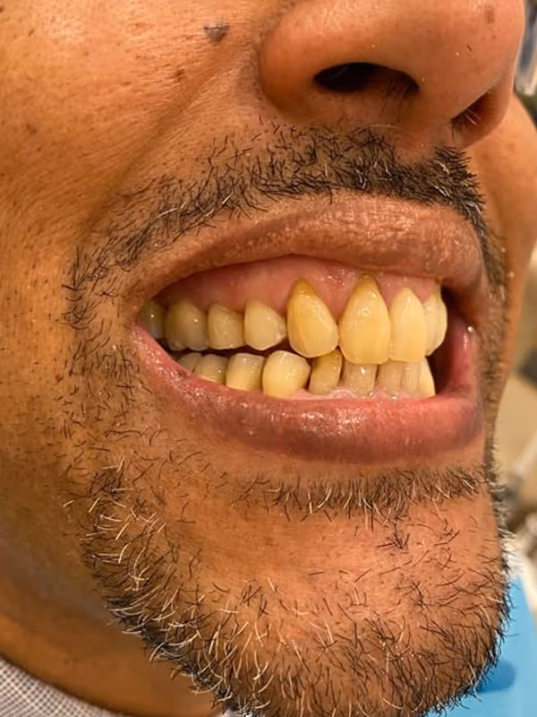 Before Treatment
