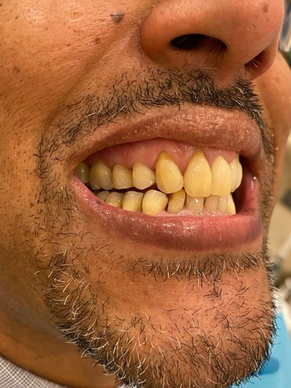Before Treatment