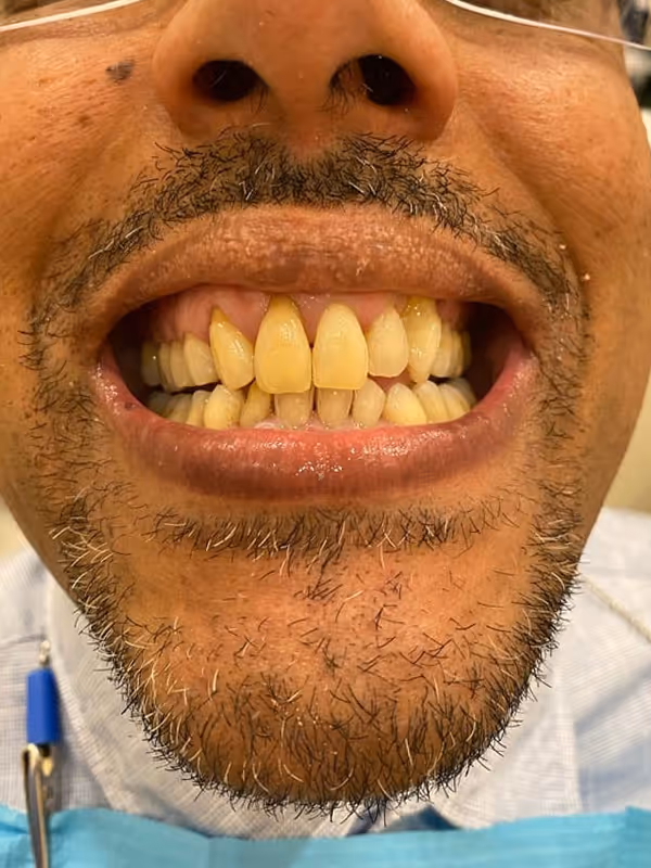 Before Treatment