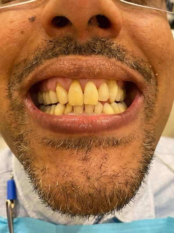 Before Treatment