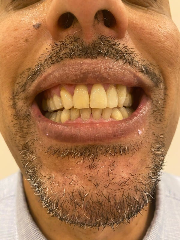 After Treatment