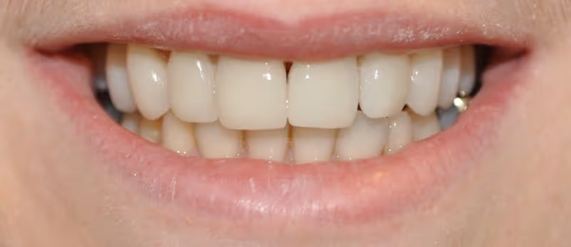 After Treatment