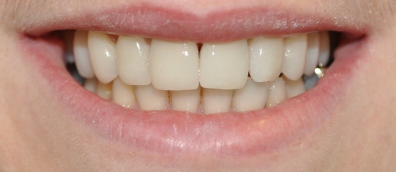 After Treatment